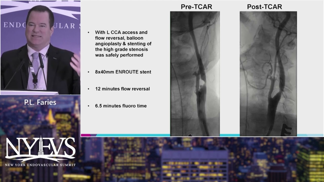 High Grade Carotid Artery Stenosis TCAR vs  Femoral Approach How Do I Choose   P  L  Faries   PAD S