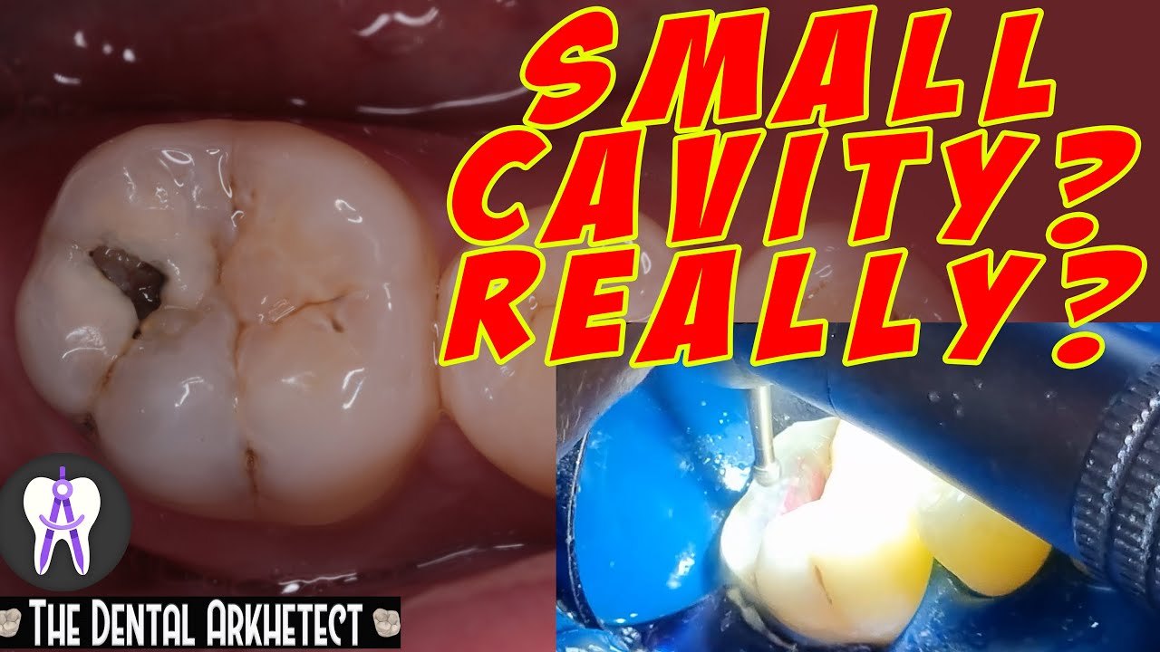 Molar Tooth Caries Removal and Restoration (Pasta sa Bagang)#42