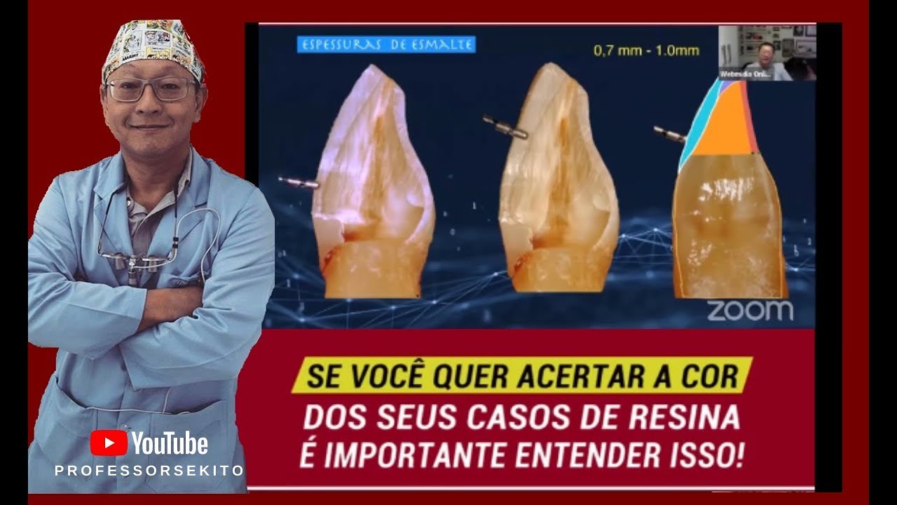 Como obter a cor ideal com resinas & a Importância da Anatomia Dental