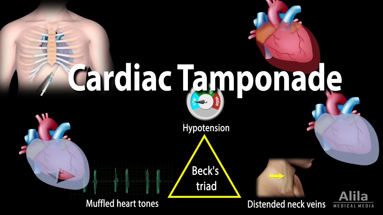 Cardiac Tamponade: Pathophysiology, Etiology, Symptoms, Diagnosis and Management, Animation