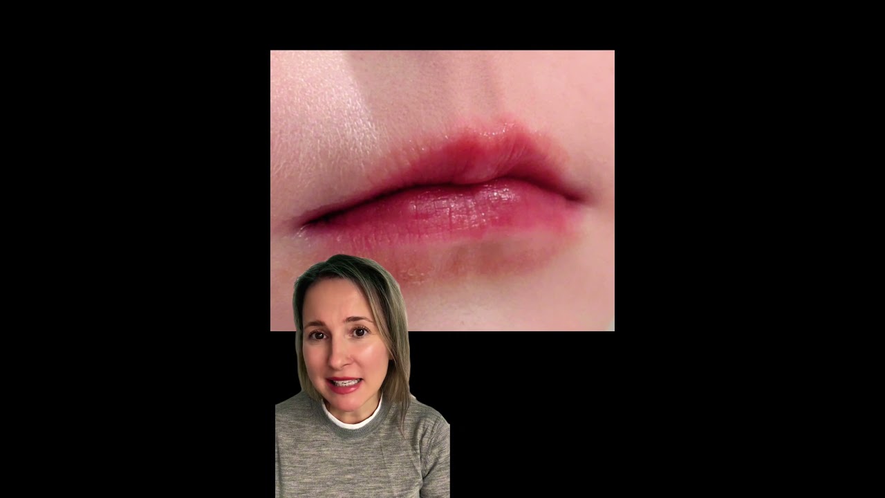 Lip licker&rsquo;s dermatitis