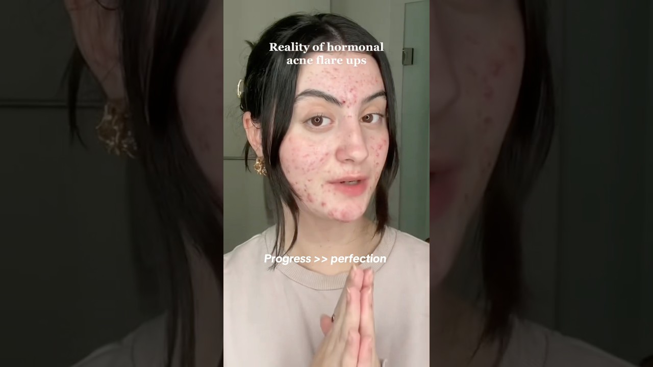 The truth about having hormonal acne 💔🥹 #realskintexture #acnejourney #skinpositivity