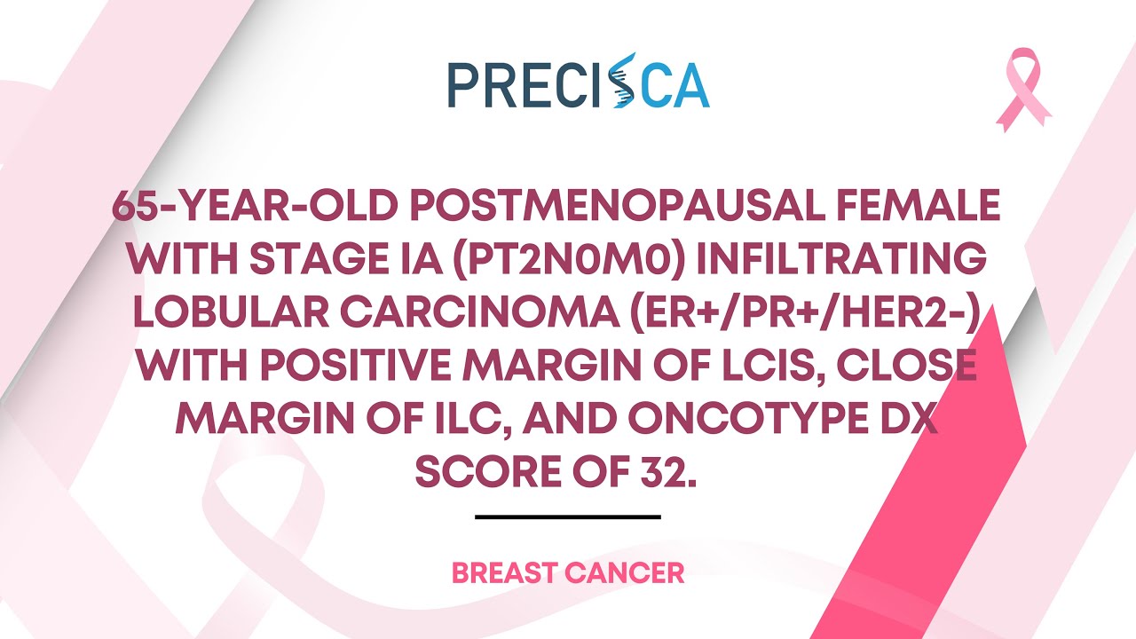 Expert Cancer Panel: Stage IA ILC w/ LCIS-positive margin, ILC close margin, and Oncotype DX of 32
