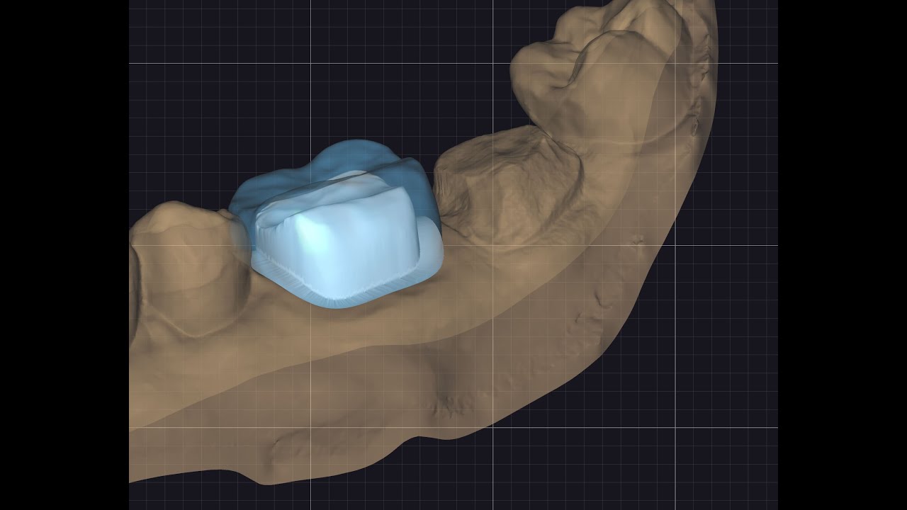 How to digitally prep teeth in exocad
