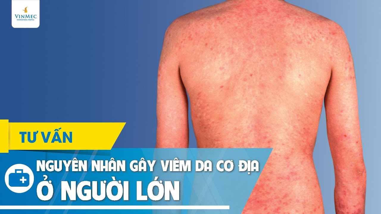 Nguyên nhân gây viêm da cơ địa ở người lớn