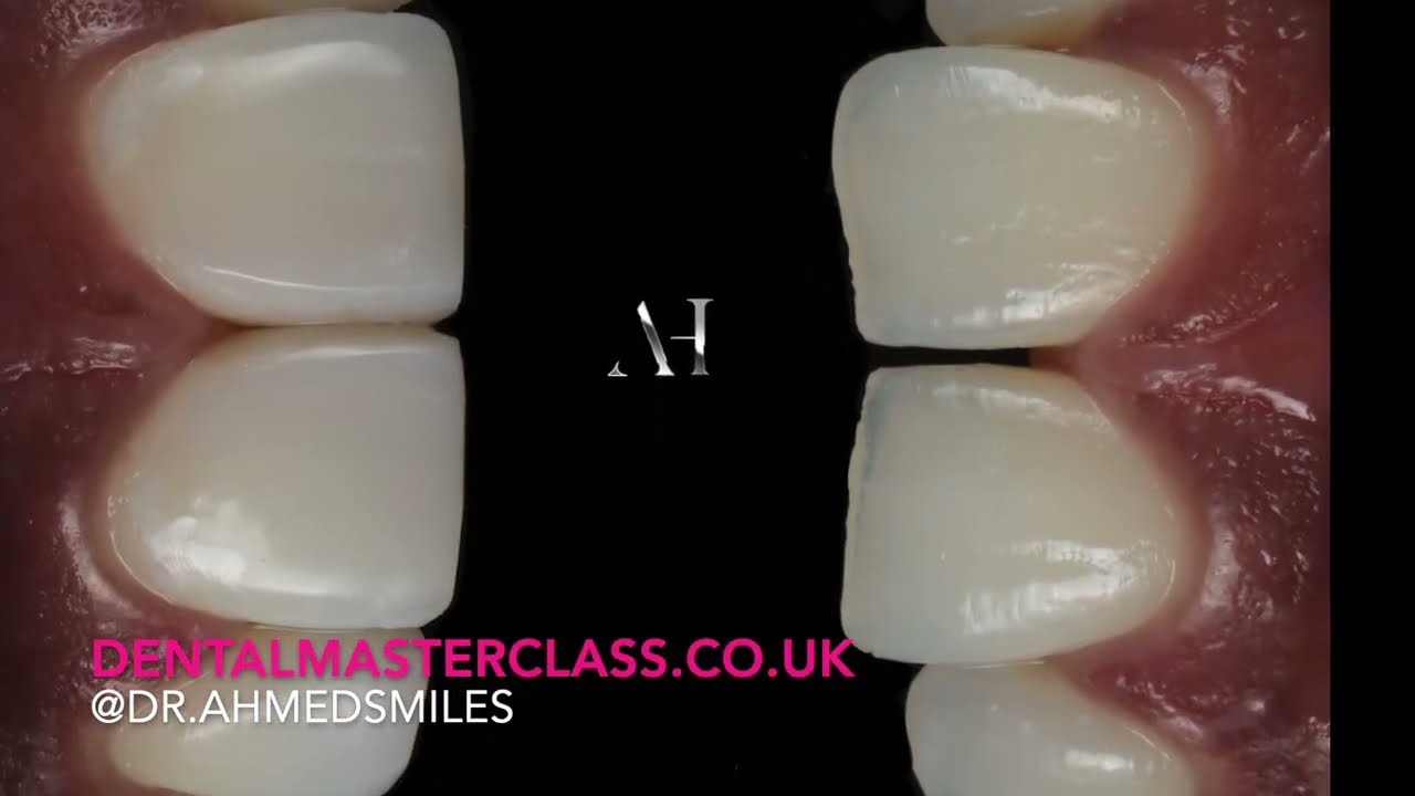 Learn the Art of Composite Veneers & Master Line Angles in our latest class at Dental Masterclass!