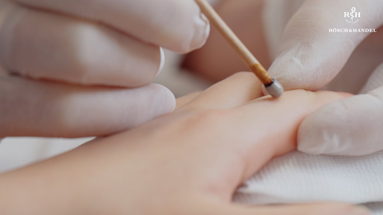 Usuwanie brodawek za pomocą patyczków z azotanem srebra SILVERIN