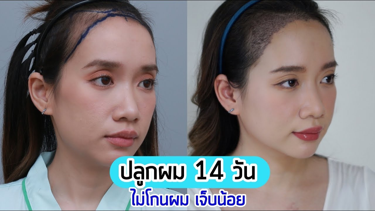 รีวิวปลูกผมผู้หญิง 14 วัน แบบ Non Shvane FUE ไม่ต้องโกนผม เจ็บน้อย พักฟื้นไว้ - Unfull Ice