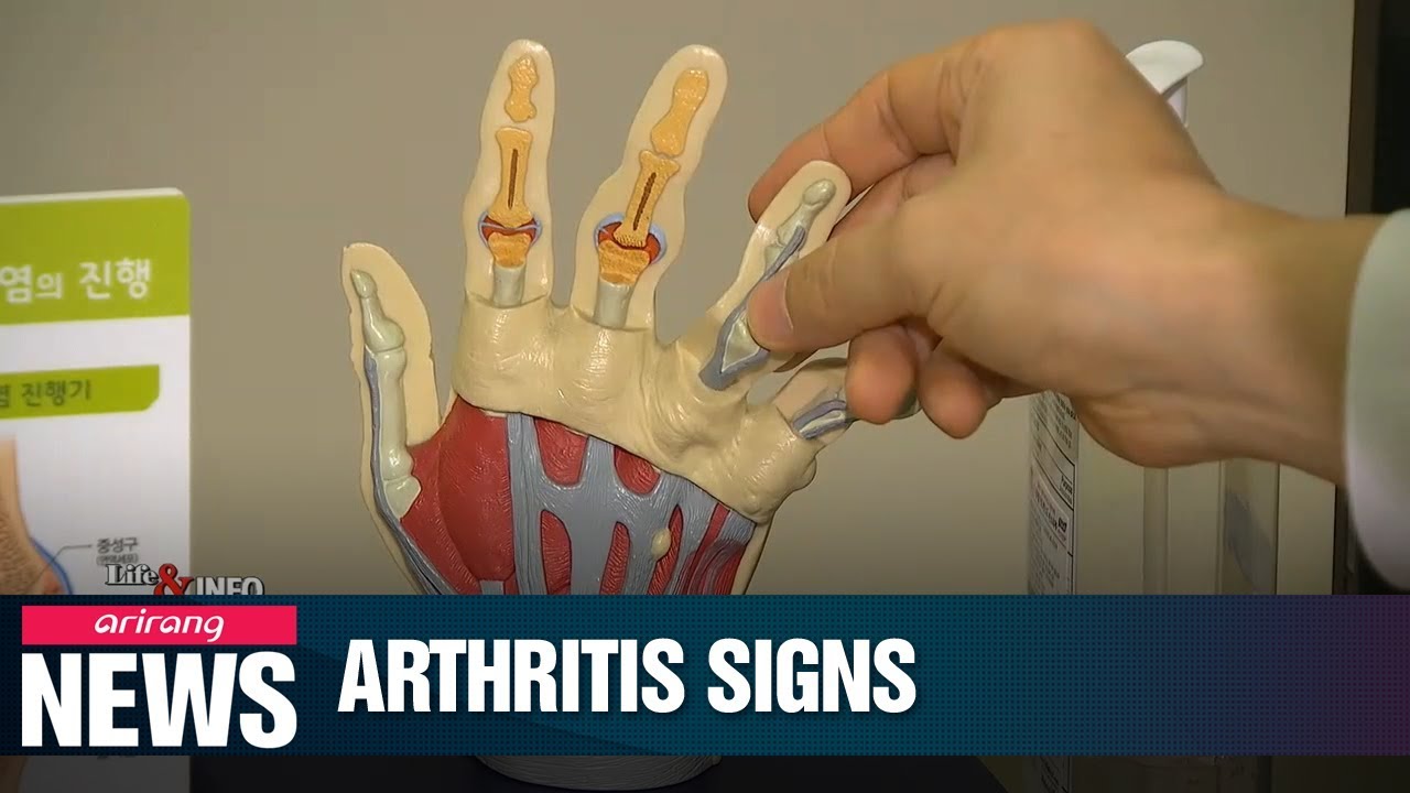 Signs of rheumatoid arthritis can show up 1-2 years before diagnosis