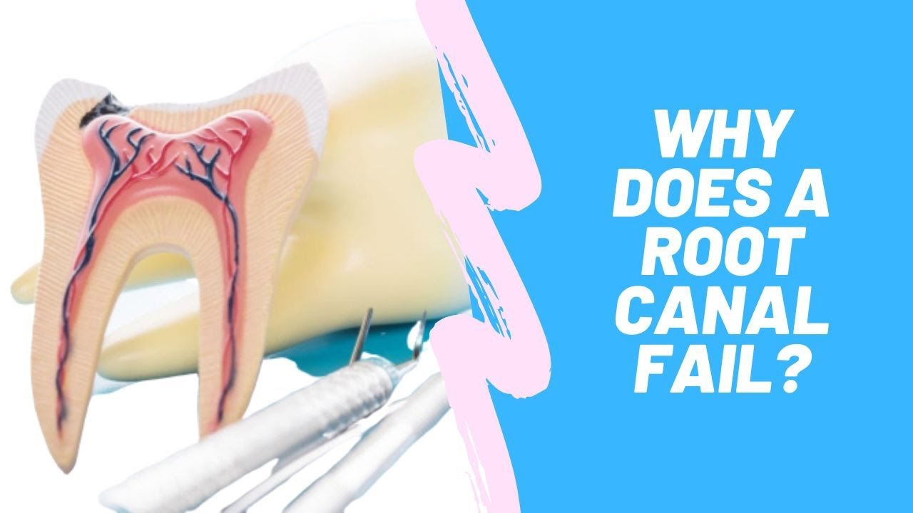 Why Does a Root Canal Fail?