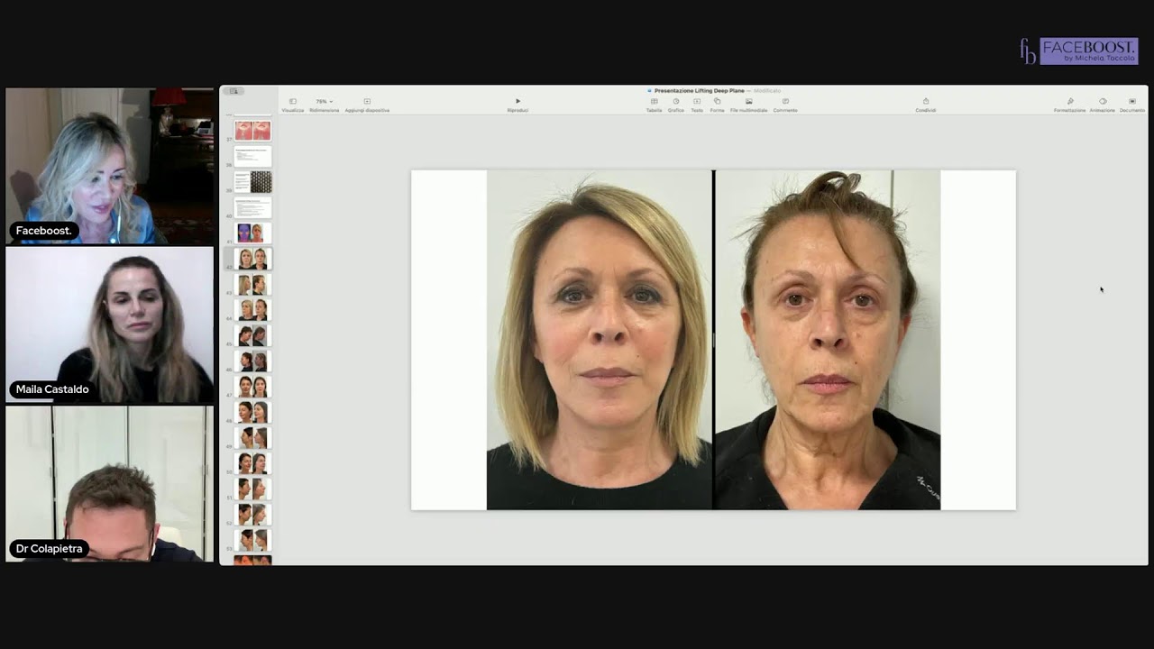 Perchè il Face Lifting. Con il dott. Alfredo Colapietra