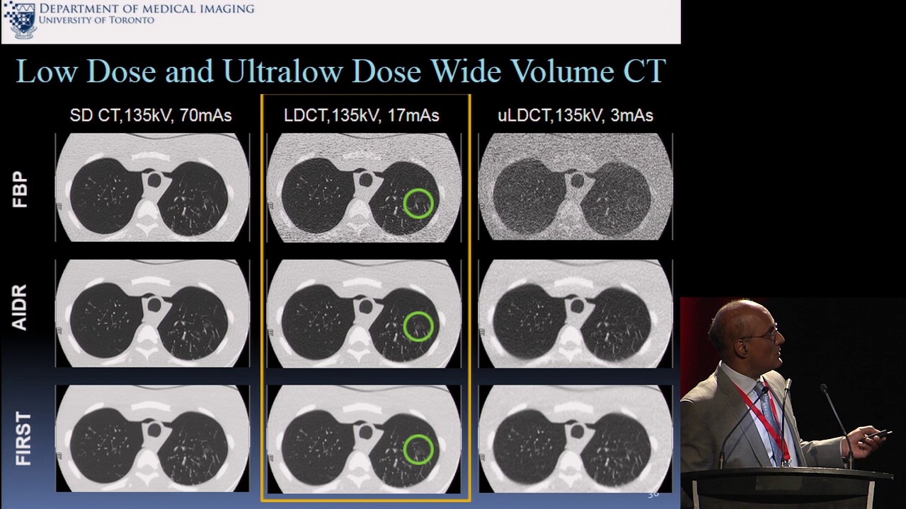Wide Volume Ultra-Low Dose Chest CT