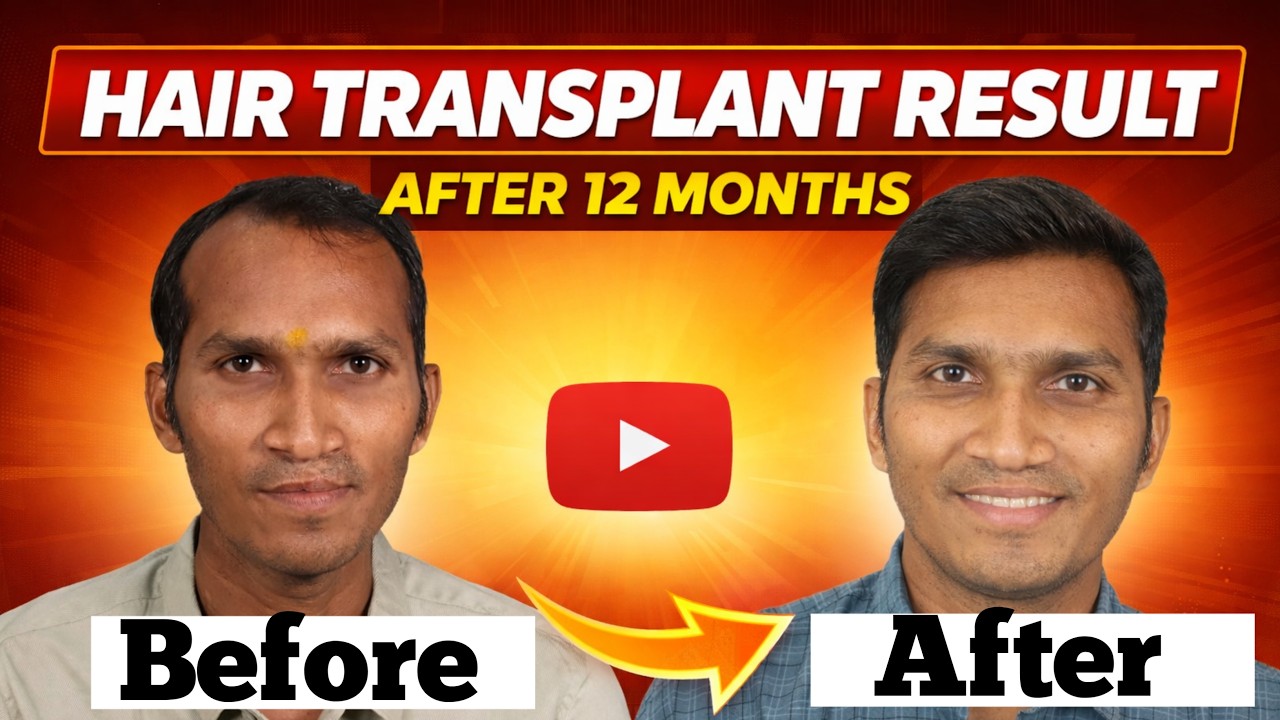My Hair Transplant 12 Months Result | Before & After |12 Months Experience