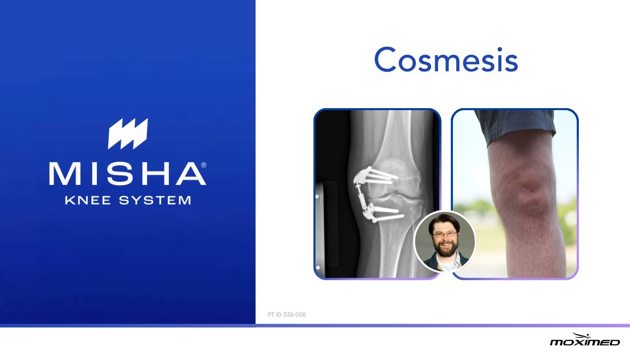 MISHA Knee System Appearance - Patient and Surgeon Perspectives