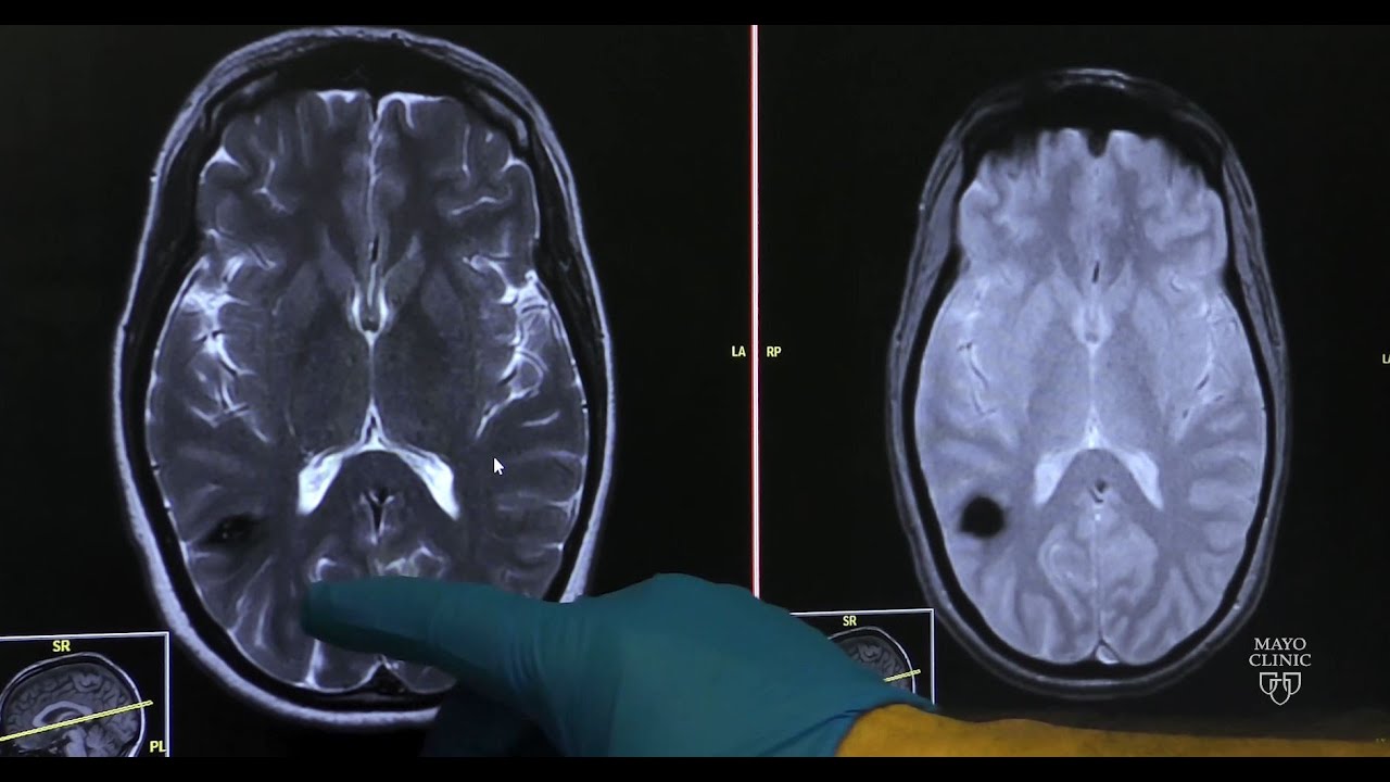 Cavernous malformations &mdash; Neurovascular disease explained