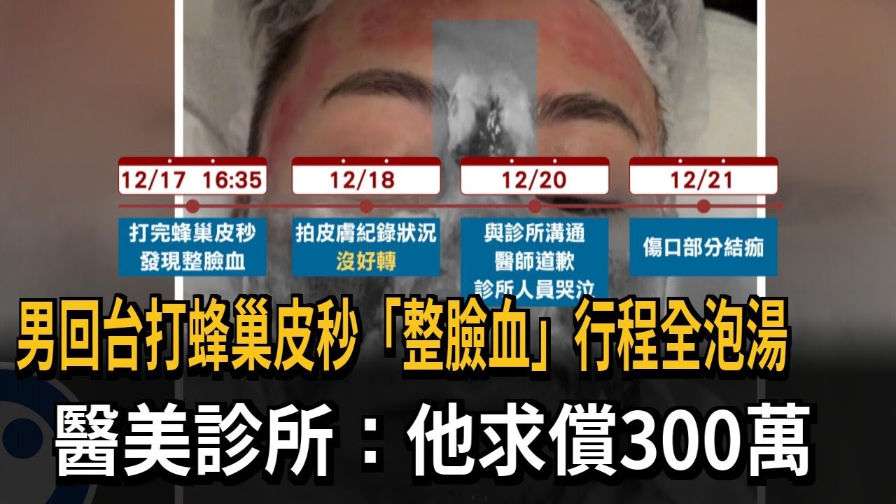 男回台打蜂巢皮秒「整臉血」 醫美診所：他求償300萬－民視新聞