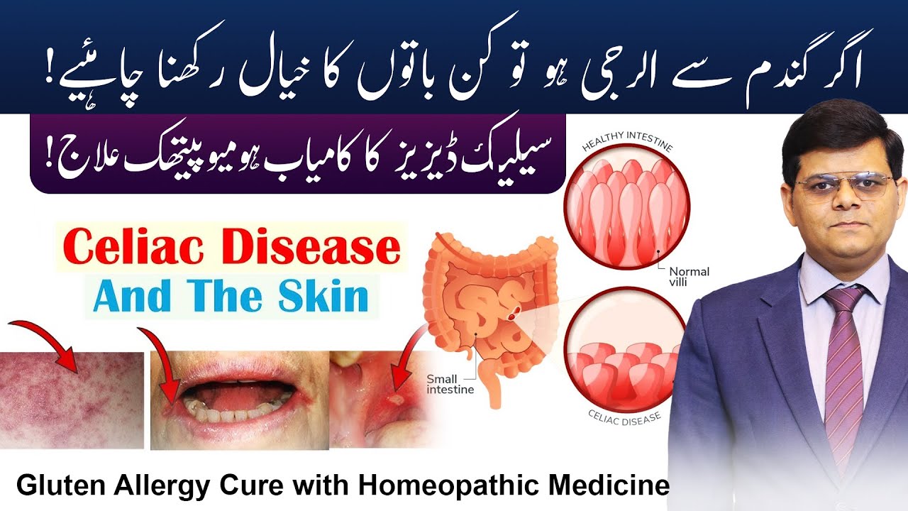 Celiac Disease In Urdu | Gluten Allergy Symptoms & Treatment | Dr Shoaib Sabir #drshoaibsabir