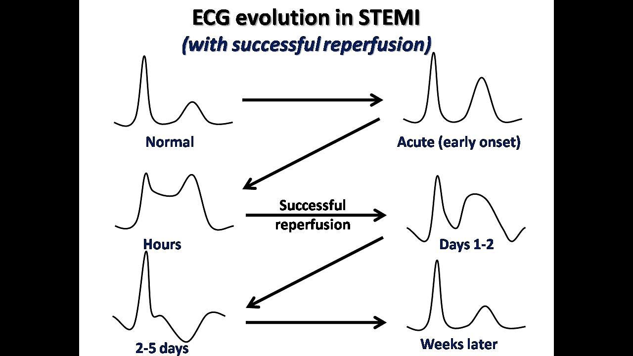 ECG course: ECG in STEMI, Dr. Sherif Altoukhy