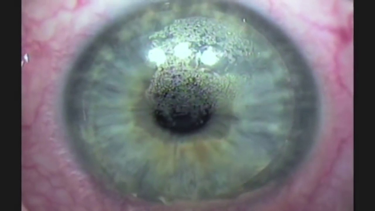 Intralase LASIK Procedure - Brad Britton, M.D.