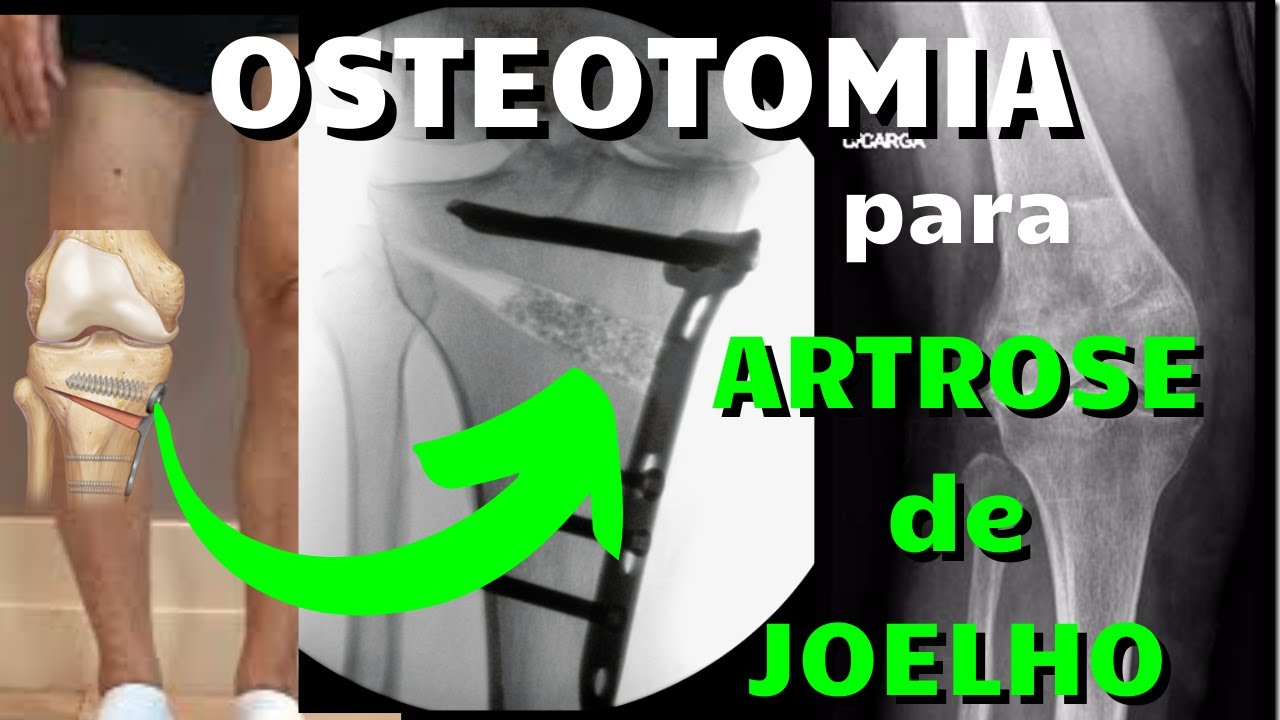 OSTEOTOMIA para tratar ARTROSE DE JOELHO