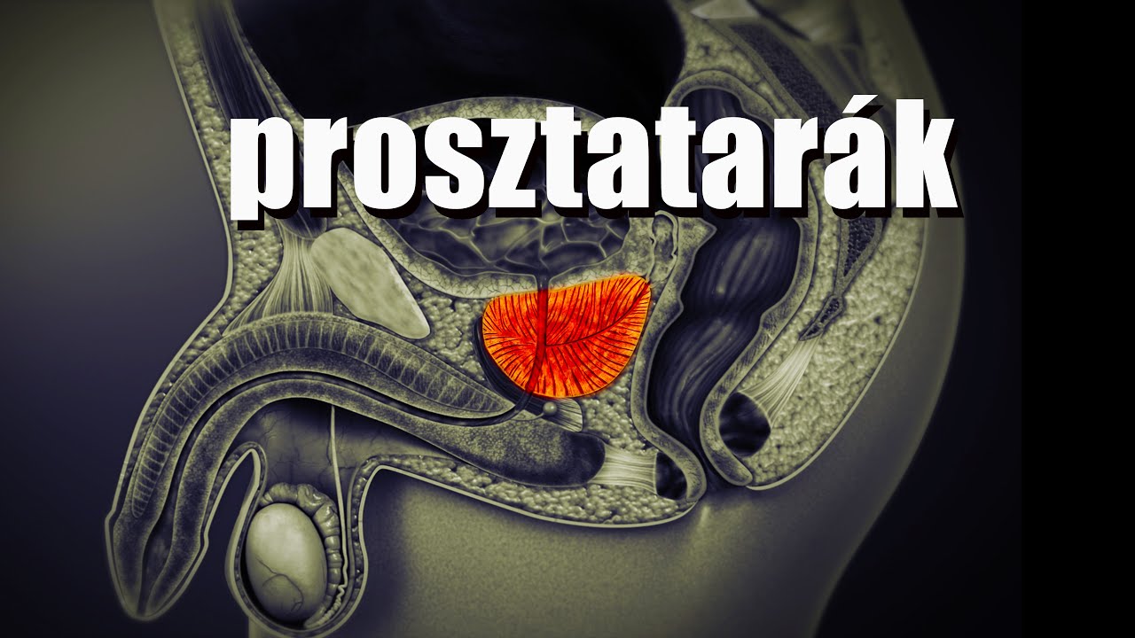 Még időben tudd meg ezt a prosztatarákról!