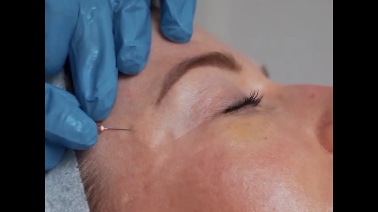 What is Carboxy Therapy?