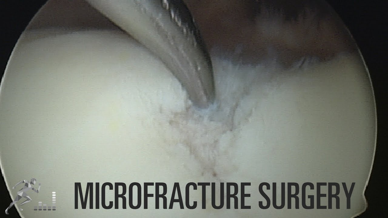 Cartilage injury and surgery: Microfracture