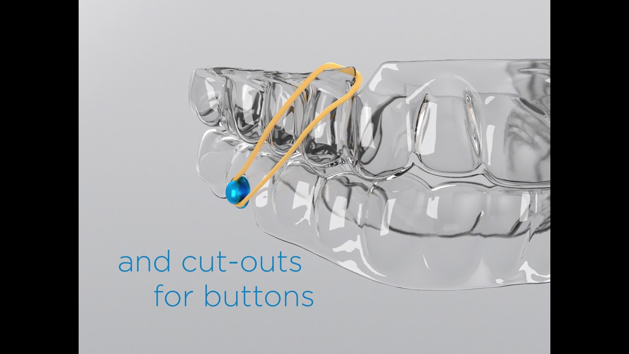 SureSmile Aligner ClassCorrection