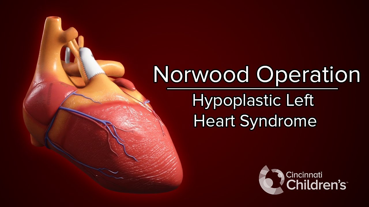 Medical Animation: Norwood Operation | Cincinnati Children's
