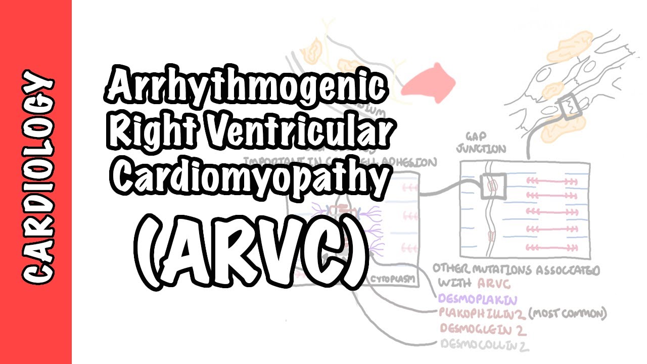 Arrhythmogenic right ventricular cardiomyopathy (ARVC) - pathophysiology, investigations, treatment