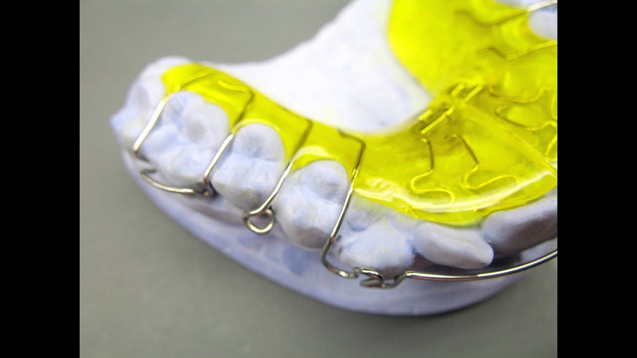 Herstellung einer Dehnplatte KFO Kieferorthopädie Orthodontics active plate Labial Bow Adams clasp