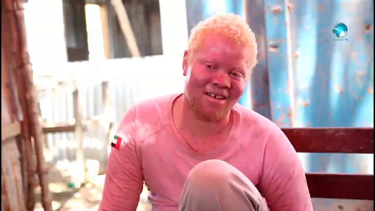 Xasan Bille ,waa nin qaba Albinism oo Ku Nool Kismaayo,Bulshada ayaa diidan in uu Baabuurta La Raaco