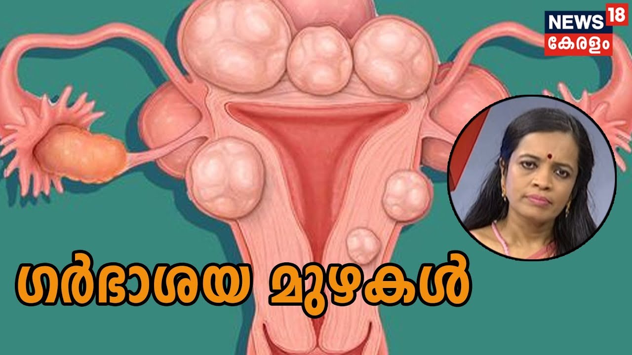 Dr. Q | ഗര്‍ഭാശയ മുഴകള്‍ Uterus Fibroid | 19th Nov 2019 | Full Episode