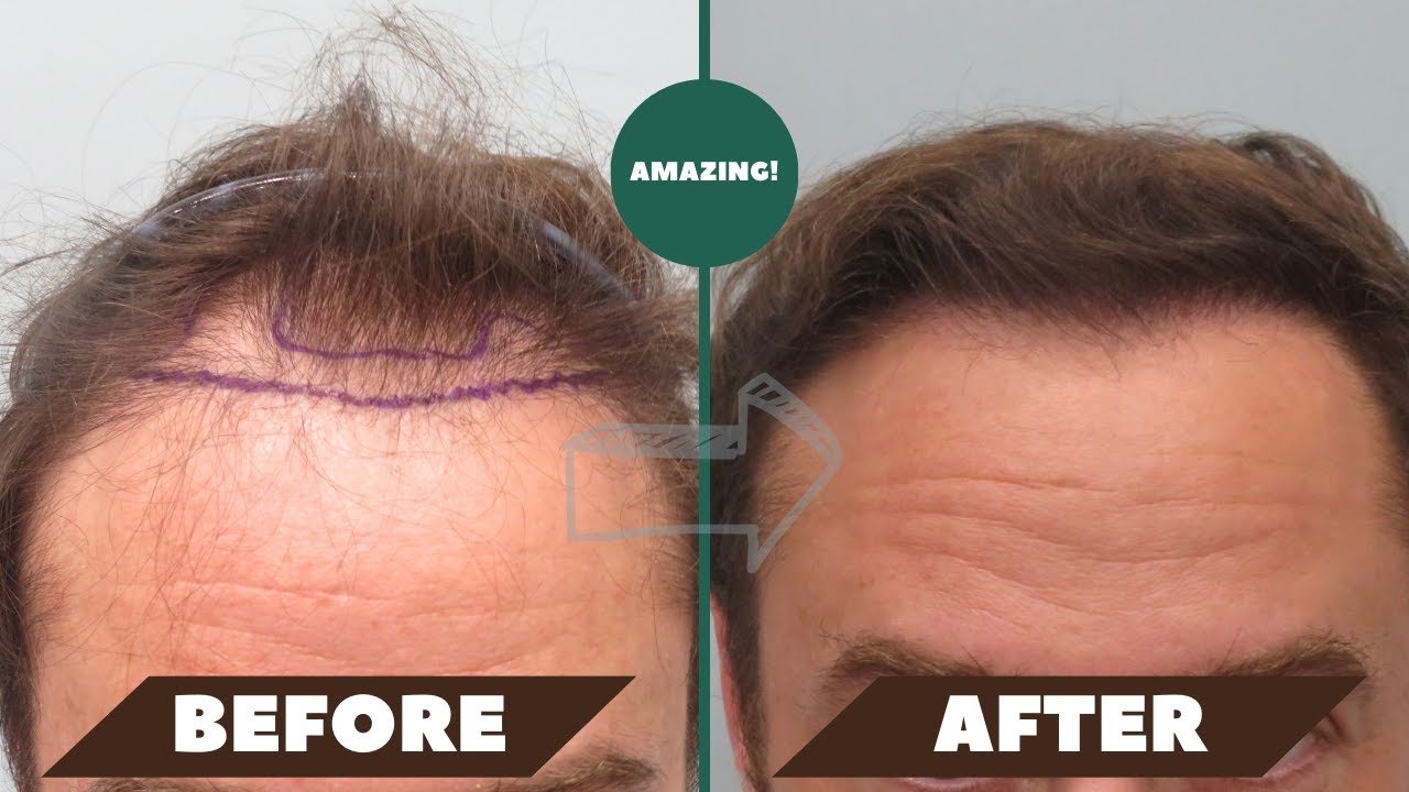 A gentleman’s testimonial about a prior hair transplant - A MUST WATCH!!