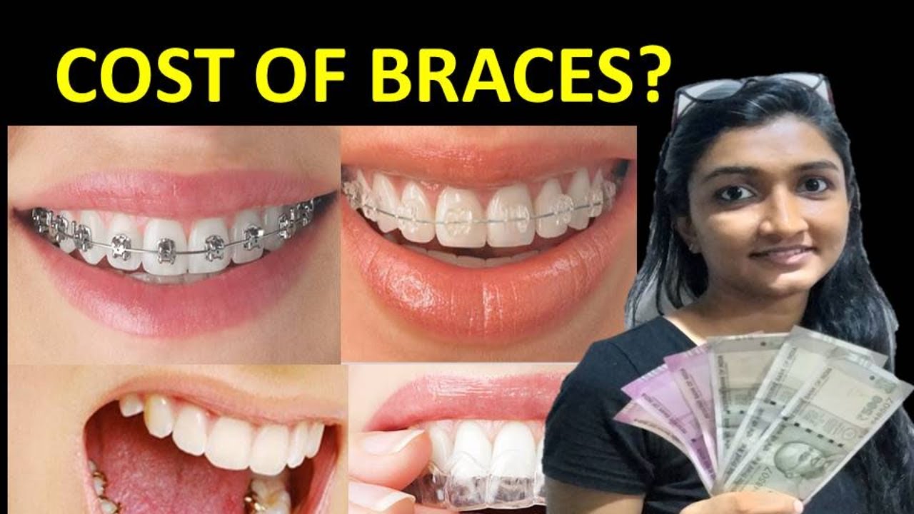 COST OF BRACES IN INDIA |Dental braces-ceramic braces-metal braces-clear aligners-lingual braces