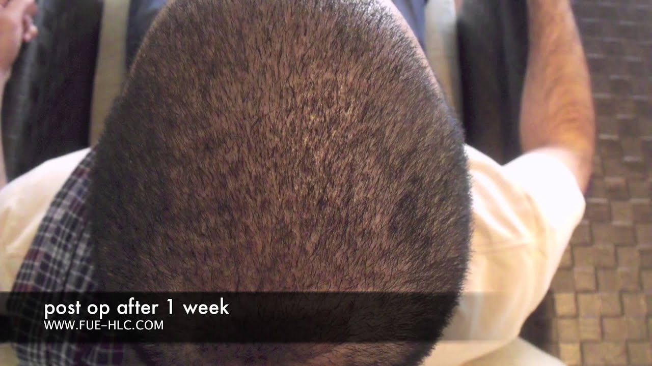 FUE Hair Transplant, Hair Transplant Repair, Hairline Clinic