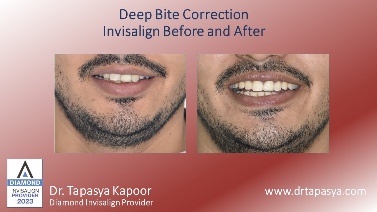 Deep Bite Correction : Invisalign Before and After