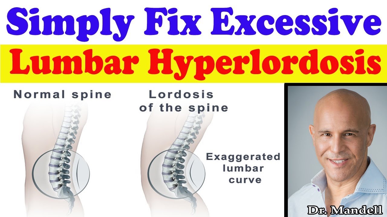 Simply Fix Excessive Lumbar Hyperlordosis - Dr Alan Mandell, DC