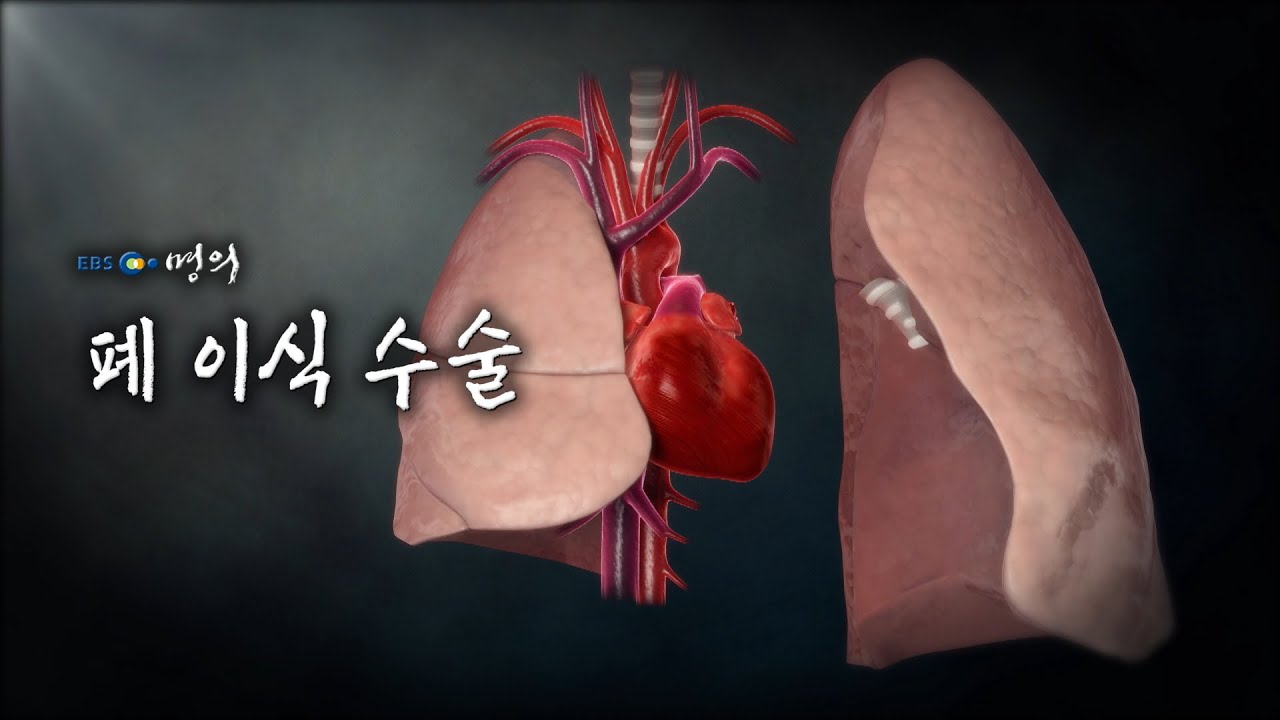 [명의 의학백과📖] 폐 이식 수술