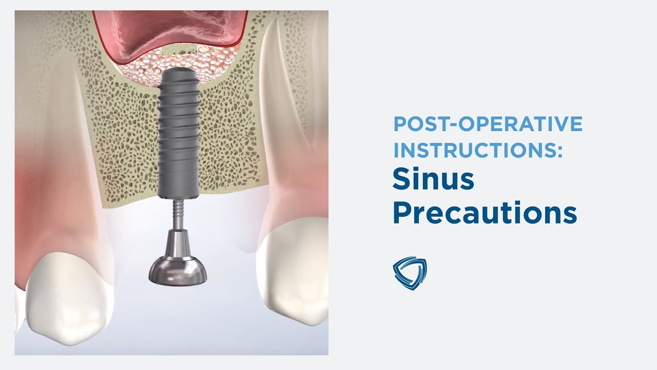 Post-Op Instructions: Sinus Surgery in Kennewick WA | Columbia Basin Oral & Maxillofacial Surgeons