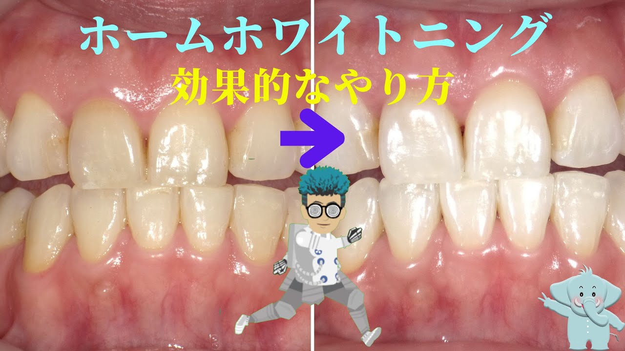 ホームホワイトニングの効果的なやり方