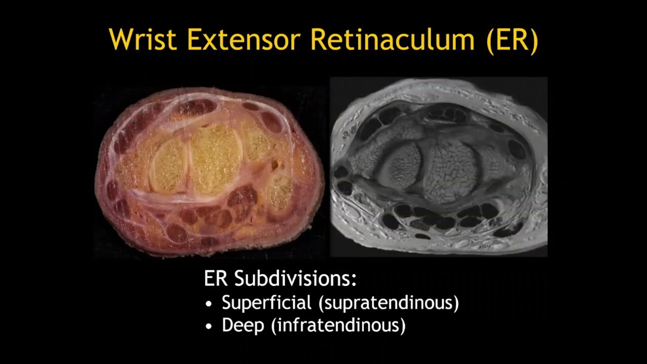 Flexor and Extensor Tendons of the Wrist by Brady Huang, M.D.