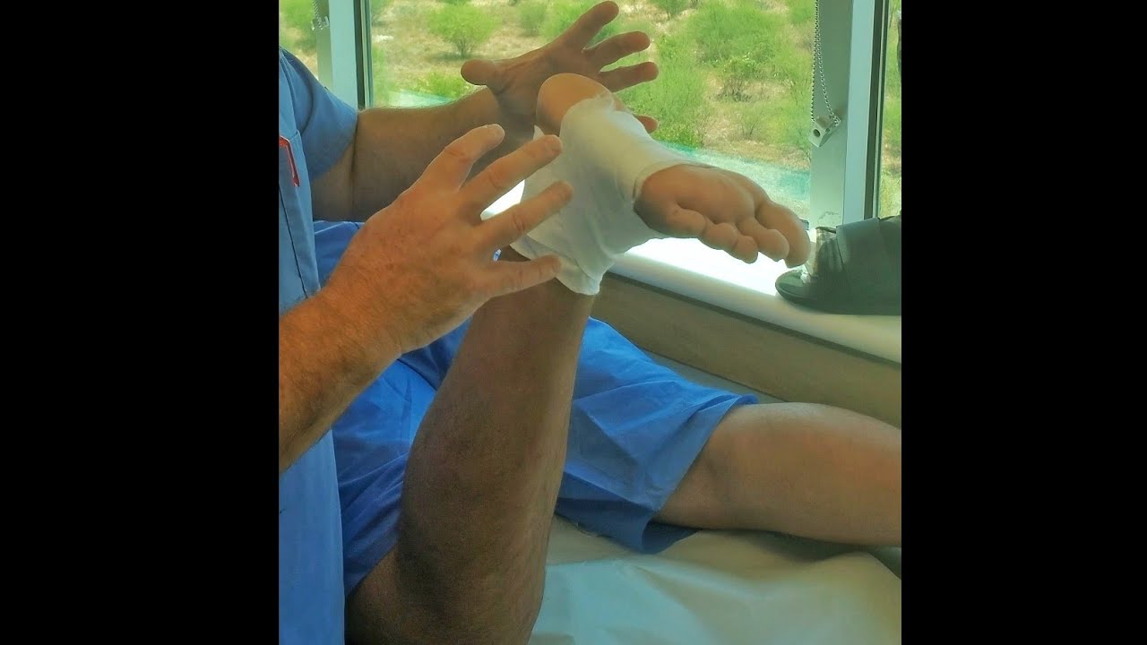 Modified Short Leg Cast for the PTTD Patient