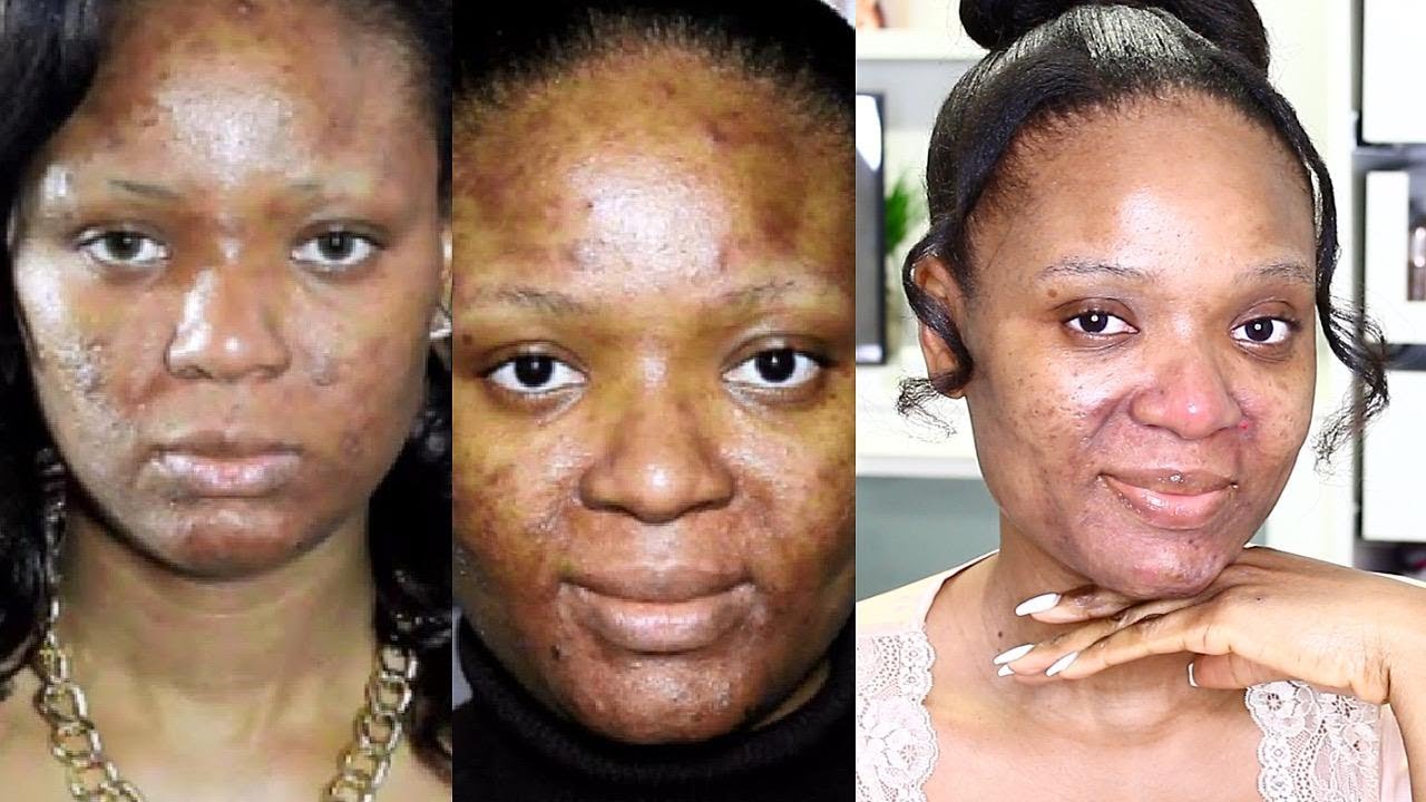 OVER 15YRS ACNE STRUGGLE!!! MY SKINCARE UPDATE | OMABELLETV