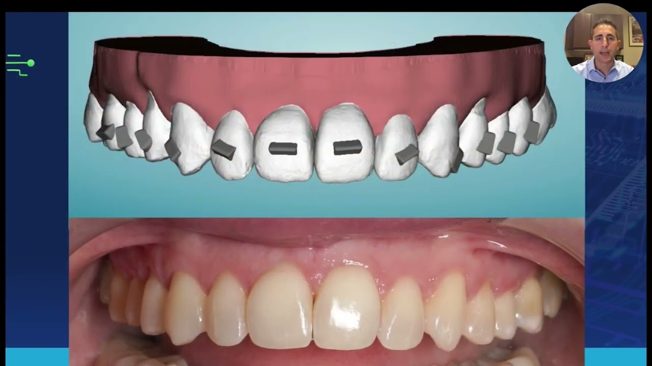 Webinar Clips: Open Bite Case with Chair-side Refinement and Fine Tuning