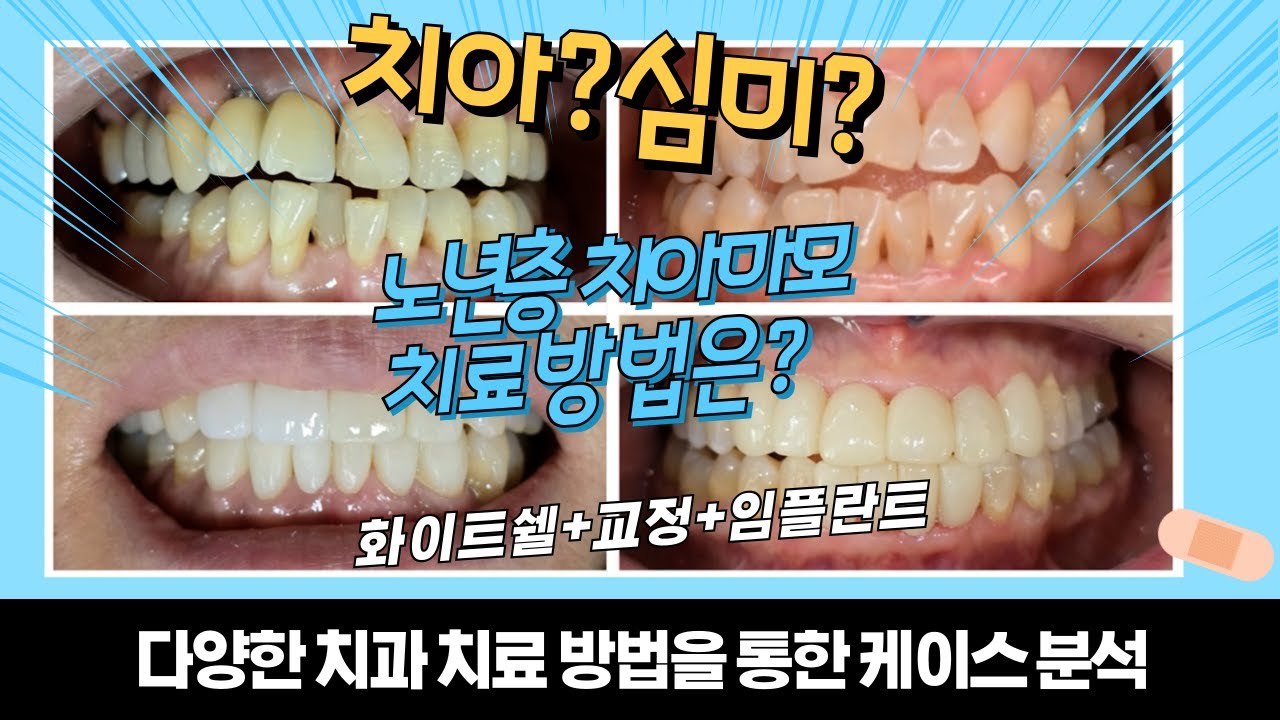 노년층 치아마모, 더 이상 고민하지 마세요! | 화이트쉘 라미네이트 & 교정치료 꿀팁