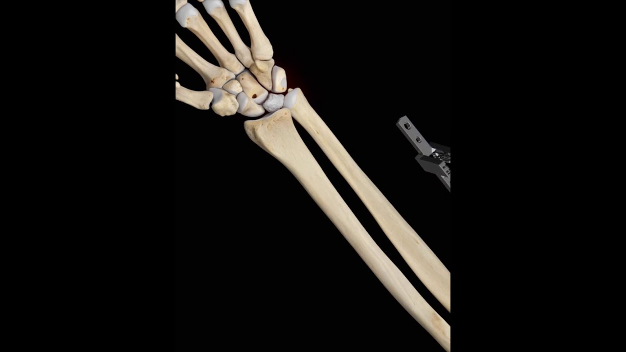 Ulnar Shortening Osteotomy - 3D Medical Animation