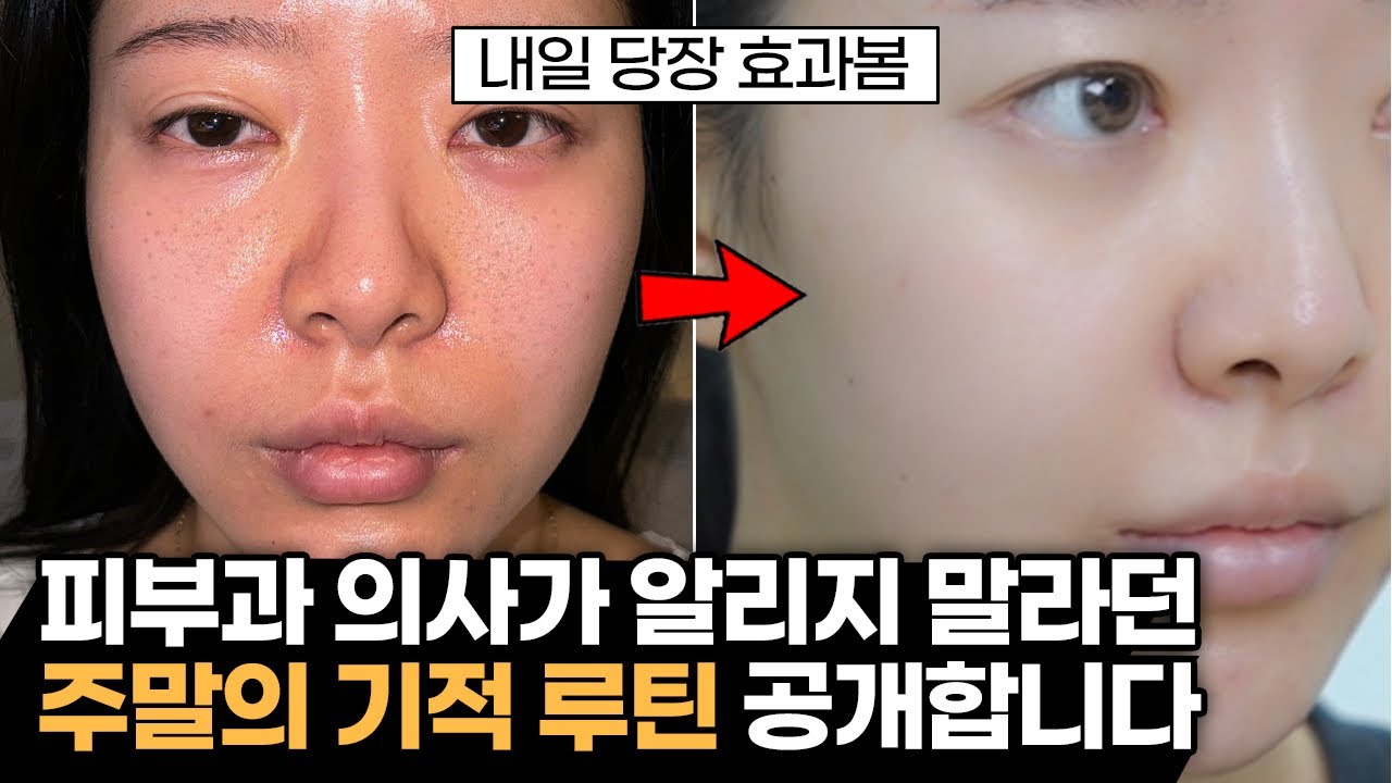 이것만 하면 피부과 안 가도 됩니다. 내일 당장 피부 좋아지는 방법 #mts