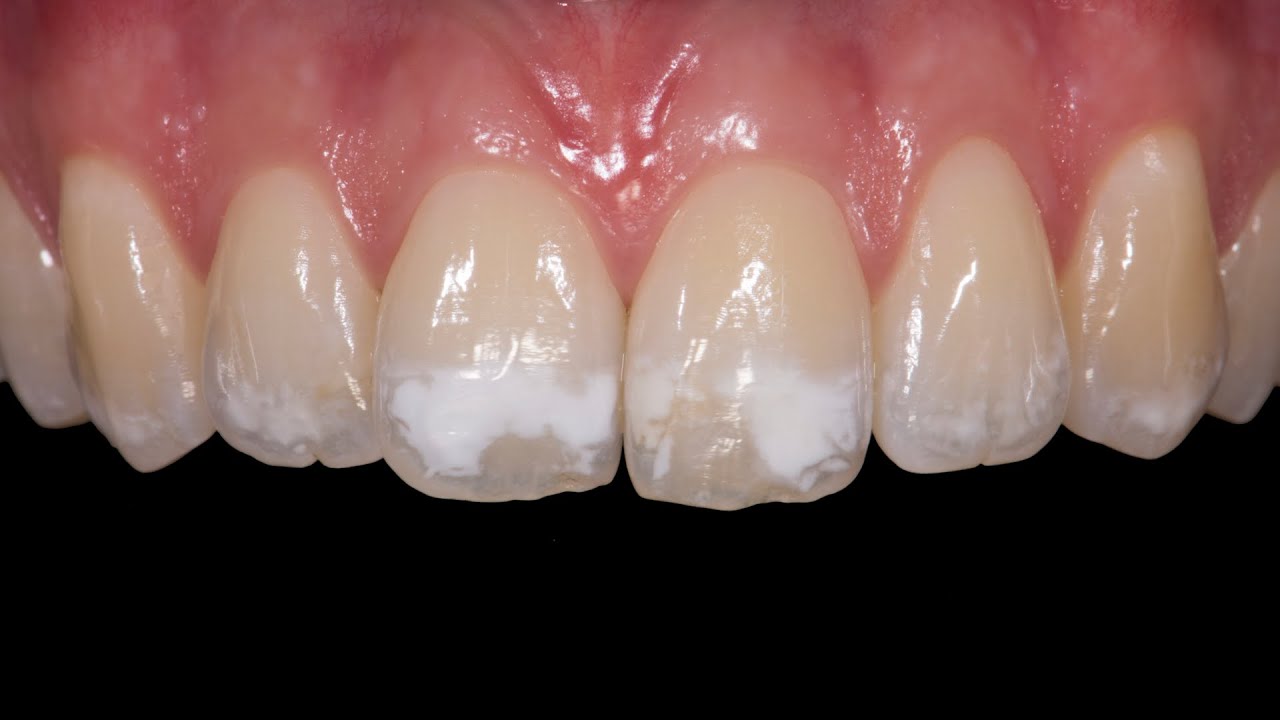 90 Day Dental Day 53- Steve Conteh - Icon Treatment for White Spots