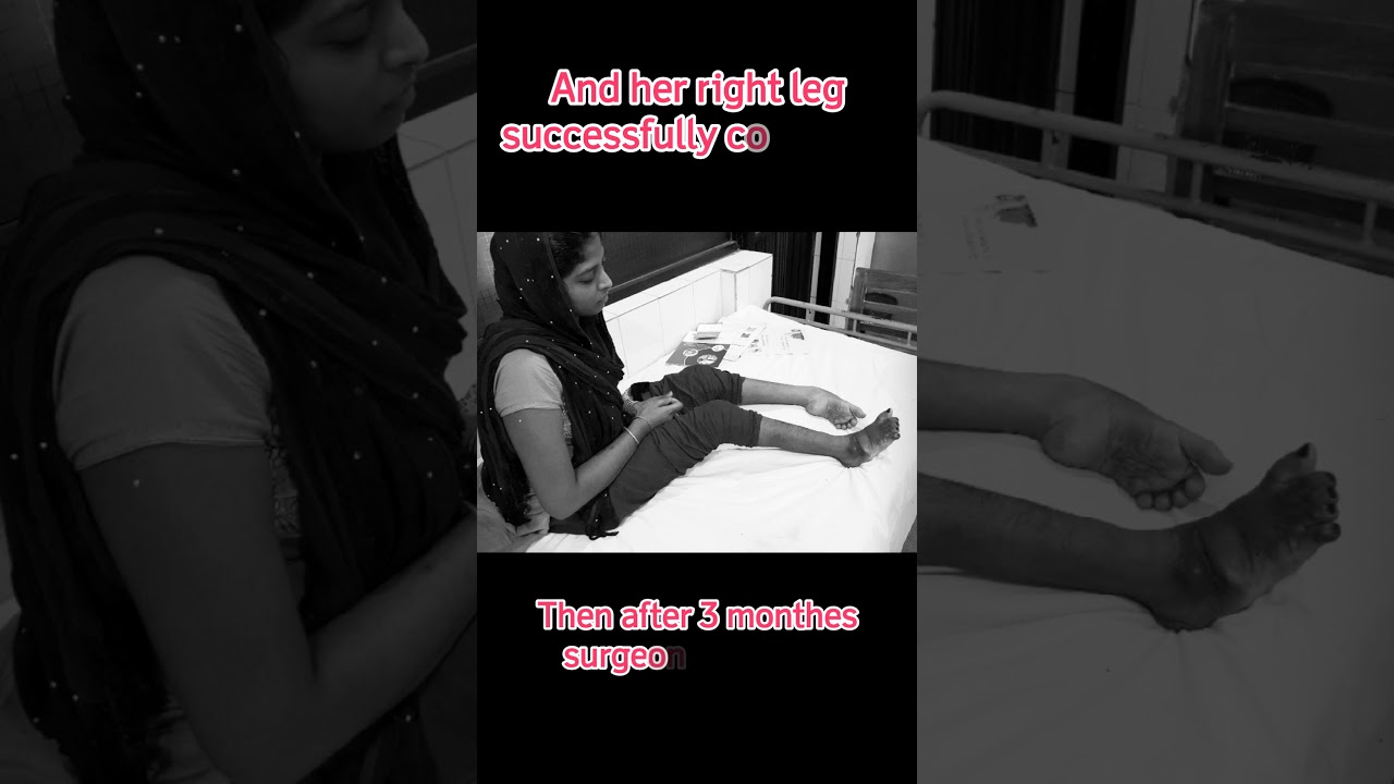 Success Story of Bilateral Clubfoot Correction